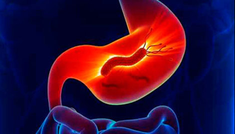 Terapijske mogućnosti u liječenju H. pylori infekcije u Republici Hrvatskoj Terapijske mogućnosti u liječenju H. pylori infekcije u Republici Hrvatskoj